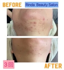 ニキビと毛穴が気になる方は光フェイシャル｜尼崎エステ