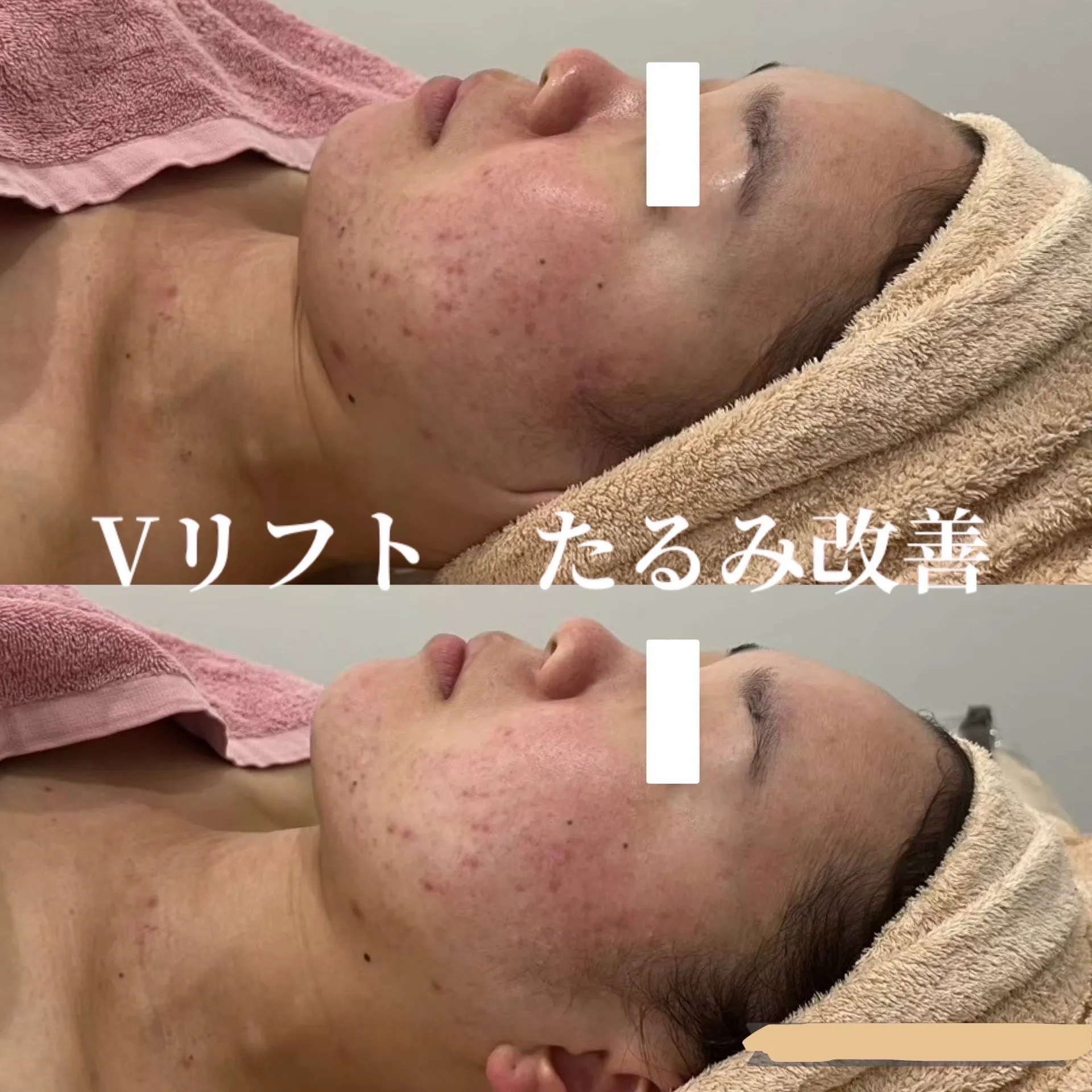 小顔　肌質改善　尼崎エステ