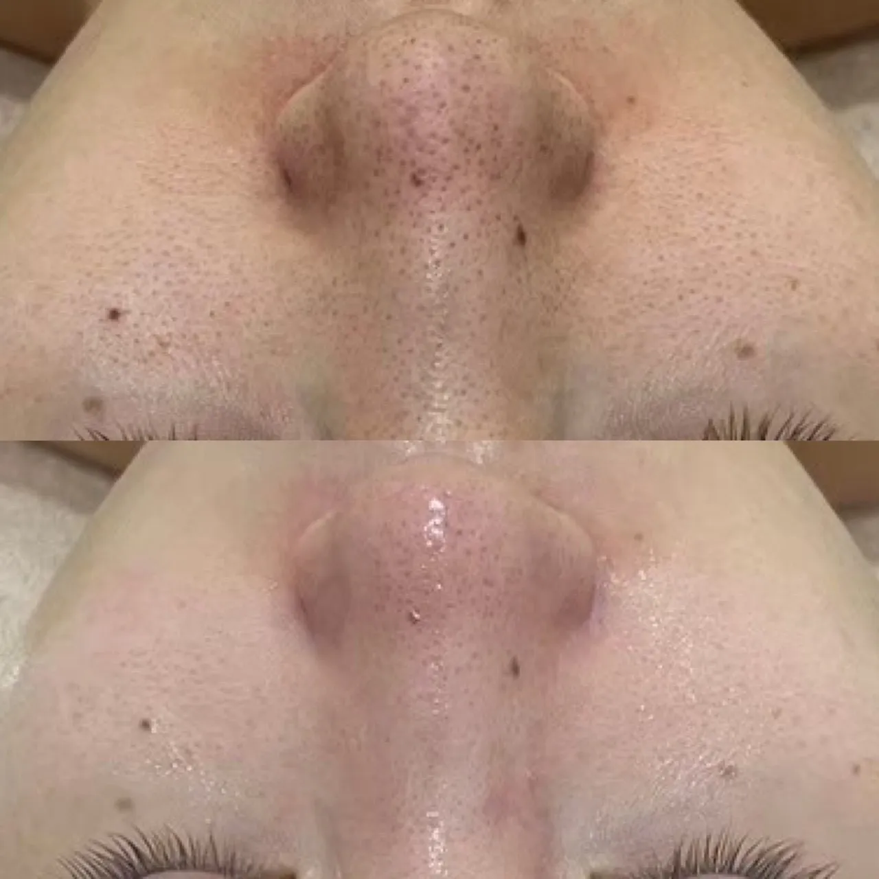 【毛穴の開きが気になる方へ】間違ったケアが原因かも。兵庫県（尼崎エステ）Rinda Beauty Salonリンダビューティーサロン