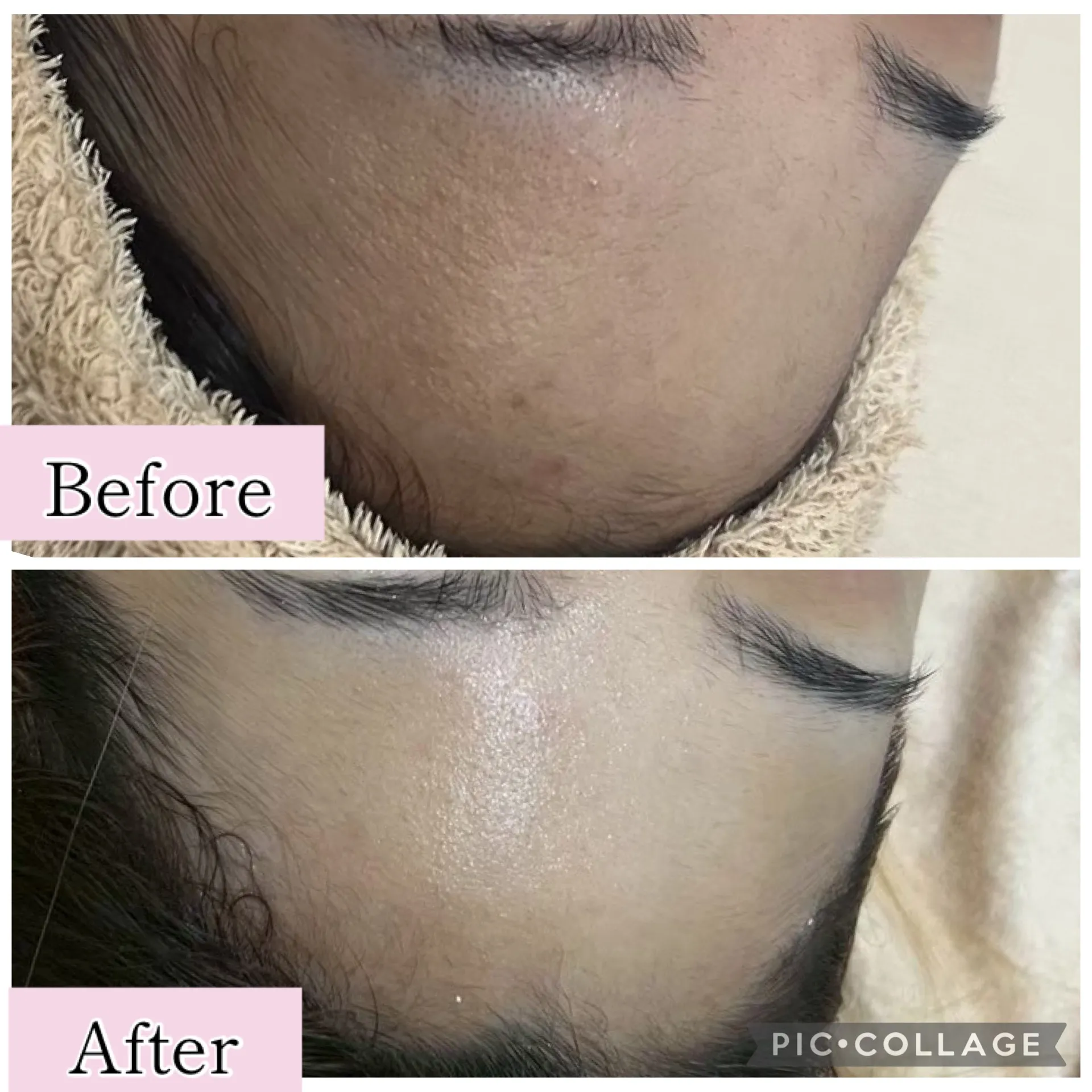 尼崎肌質解決フェイシャルエステ【尼崎で肌質の根本改善｜ニキビ・ニキビ跡・シミに悩む方へ