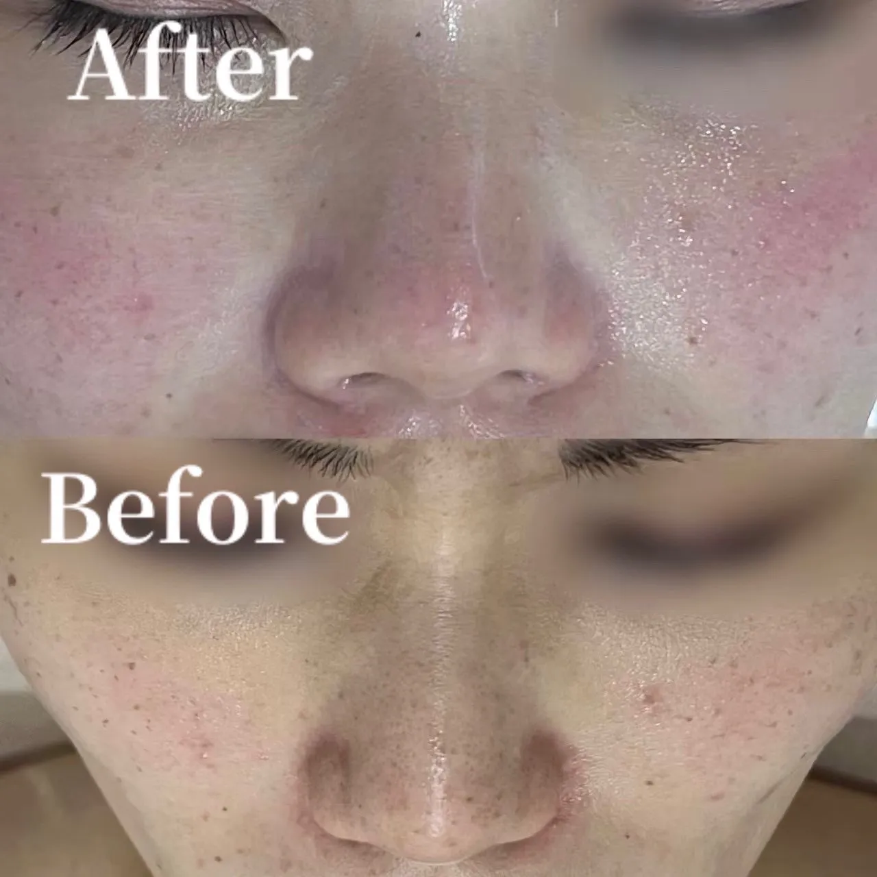 「尼崎で毛穴黒ずみ改善なら｜毛穴洗浄・ハーブピーリング専門サロン」