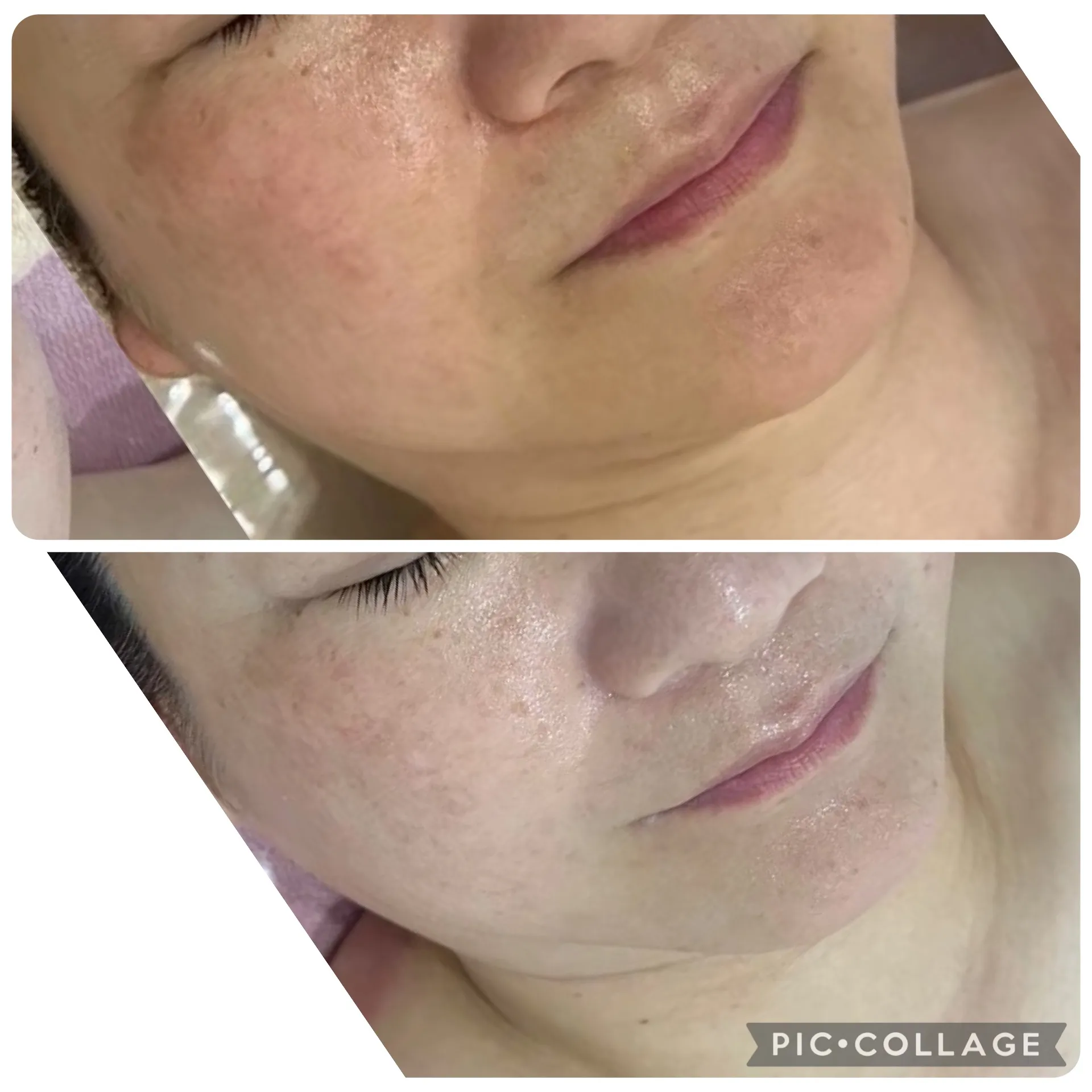 小顔、たるみ、ほうれい線、マリオネット（口横のたるみ）を改善したい方はJR尼崎リンダRindaで渡韓せずに韓国美容で改善しませんか？