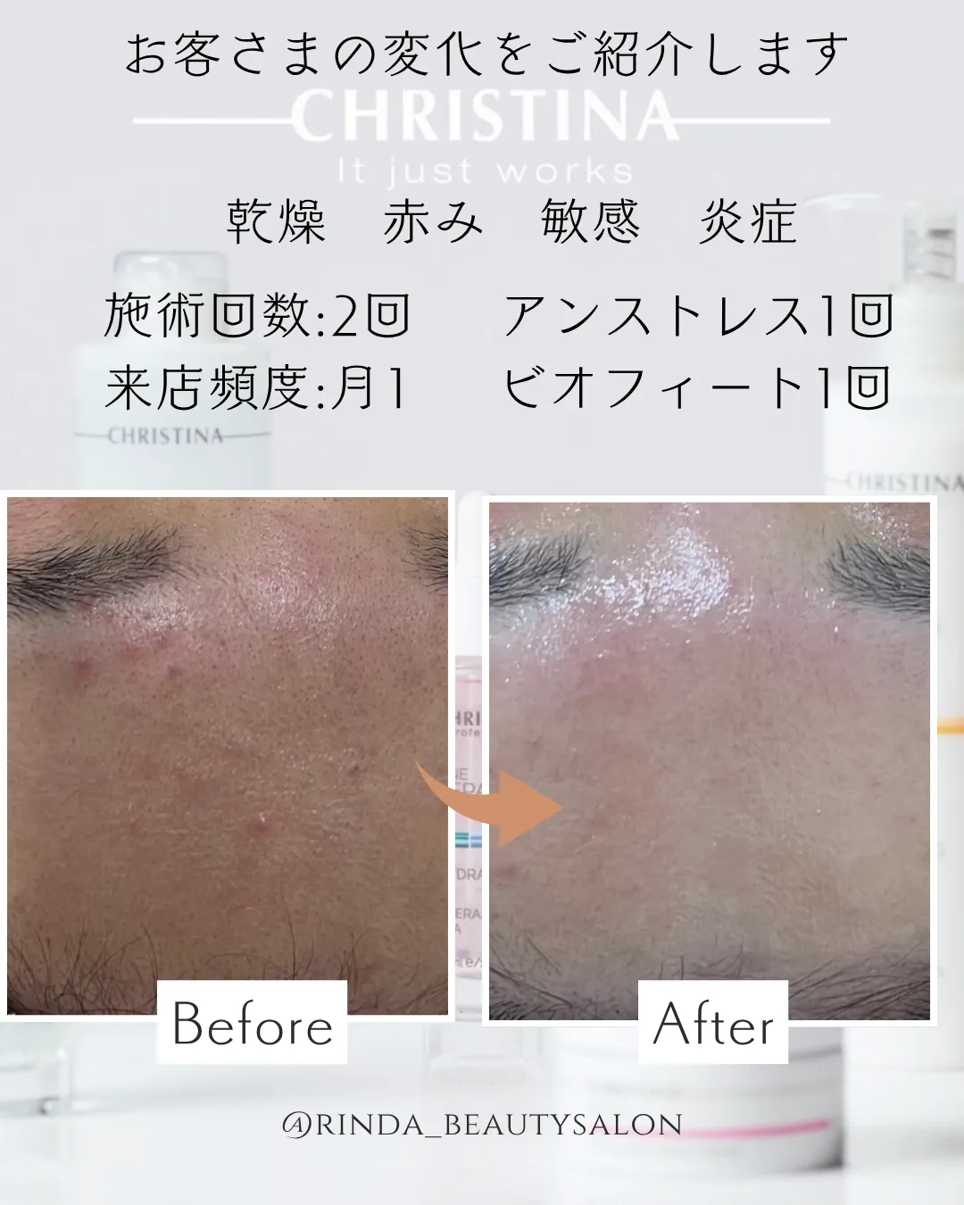  【尼崎で繰り返すニキビ・ニキビ跡赤みの改善しませんか？兵庫県（尼崎エステ）RindaBeautySalonリンダビューティーサロン