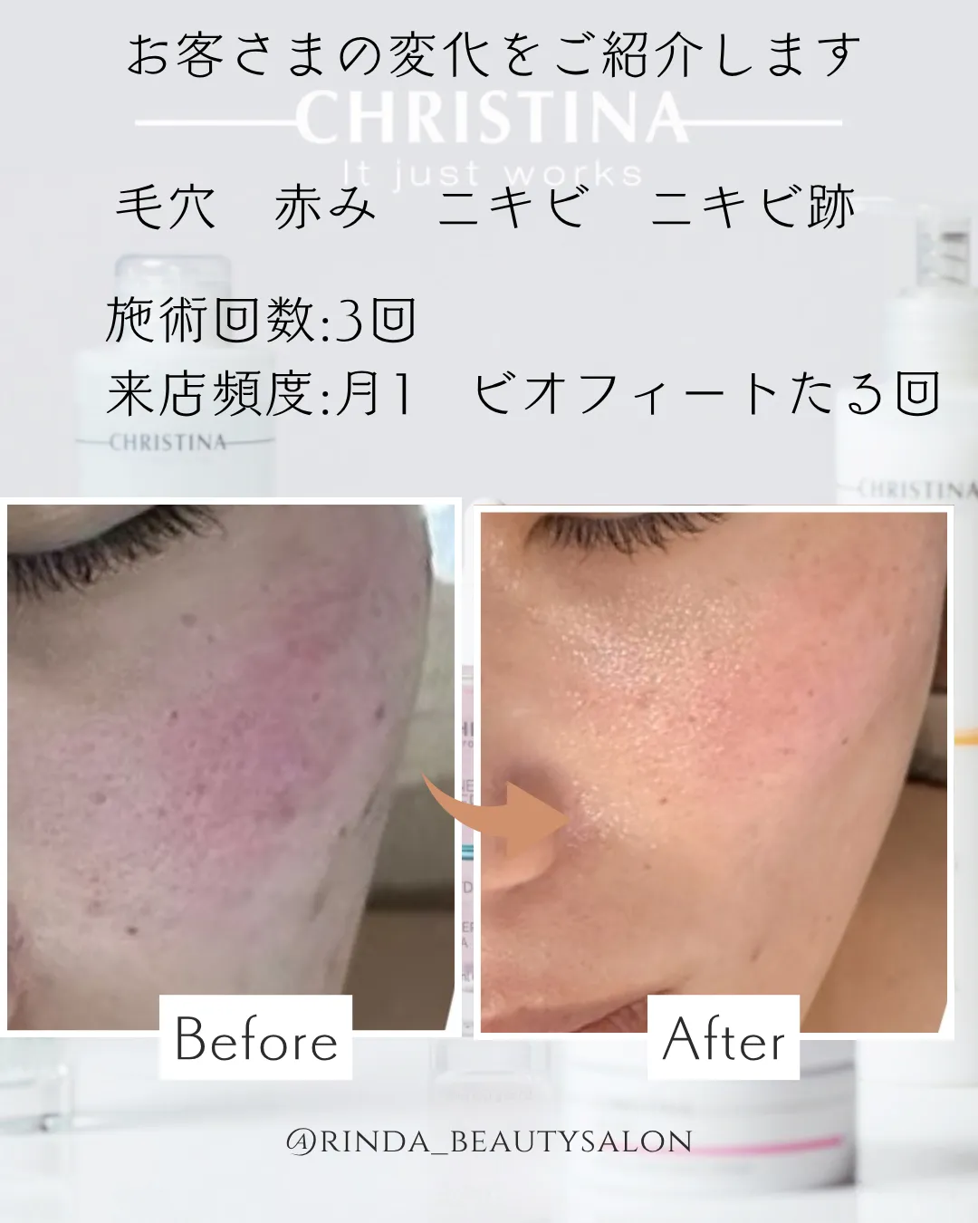 【尼崎駅前エステサロン/肌質改善】4月のゆらぎ肌に…花粉・乾燥・赤みを徹底ケア！