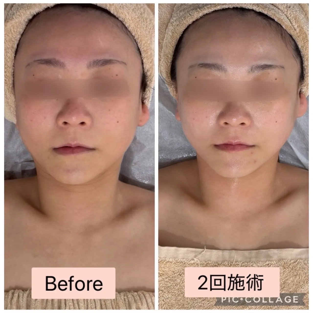 【尼崎/小顔】30代からのたるみ・左右差に。食いしばり肩こりもスッキリ！溶ける針で肌質改善