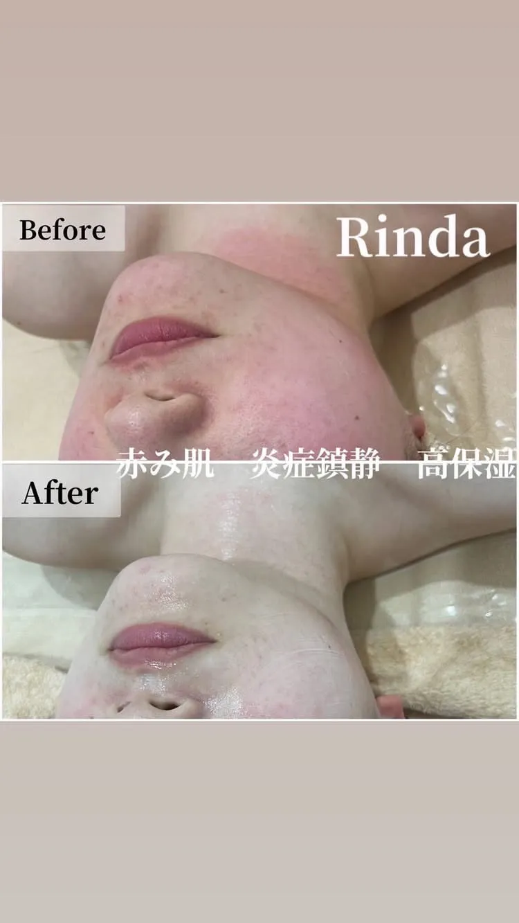 尼崎駅前徒歩2分！尼崎の30代以降女性で赤み・敏感肌にお悩みの方へ｜繰り返す肌荒れを鎮静ケアで根本改善