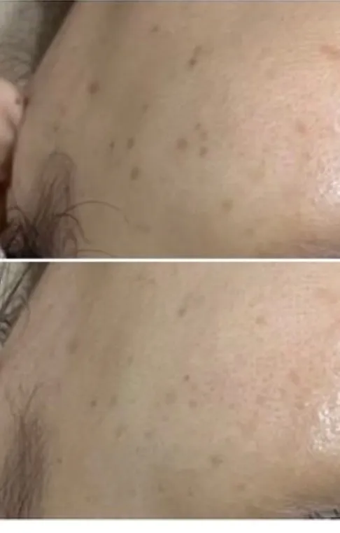 【尼崎肌質改善エステ】シミ改善｜ハーブピーリング1回でここまで変わる理由とは？