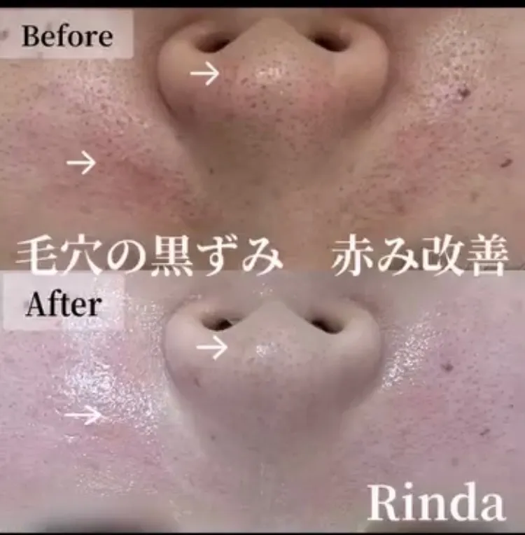 尼崎で毛穴改善したい30代女性へ｜開き・黒ずみ・たるみ毛穴の本当の原因と対策