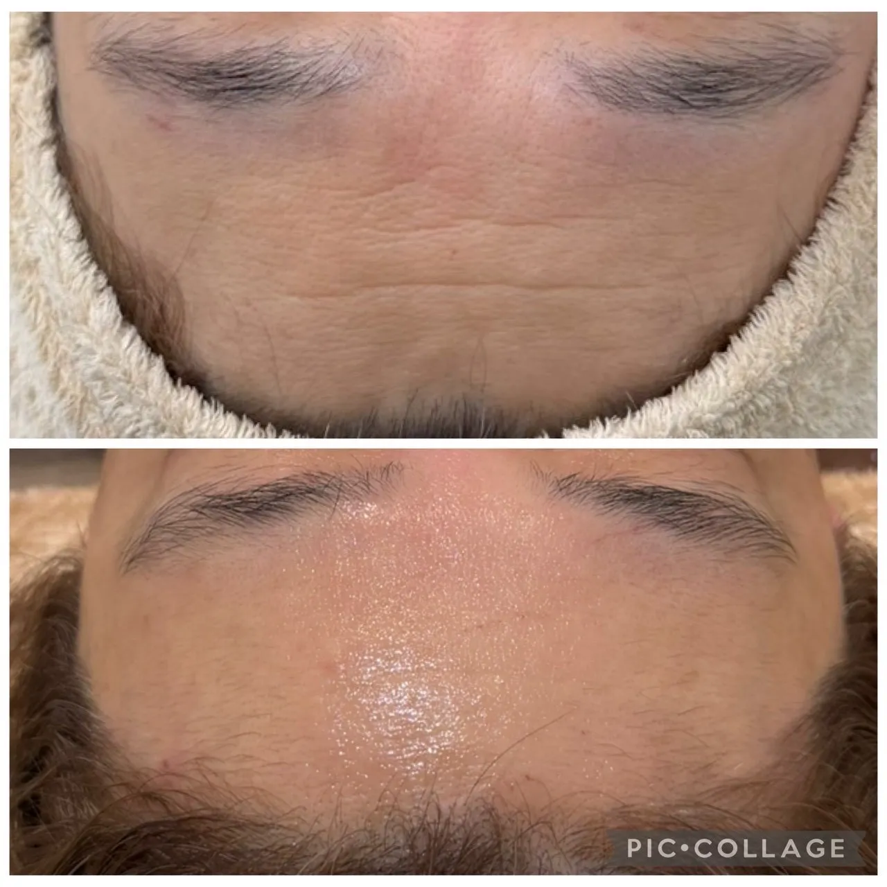 額のシワが気になり始めた方へ｜JR尼崎駅徒歩２分の肌質改善エステ