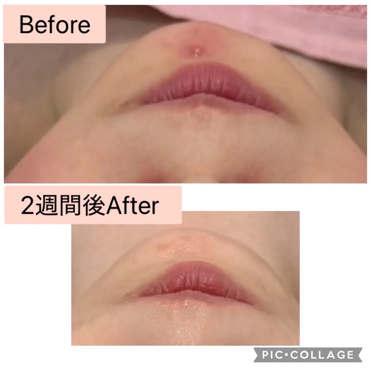 尼崎エステ肌質改善サロン【繰り返す口周りニキビ】2週間でここまで変わる理由とは？
