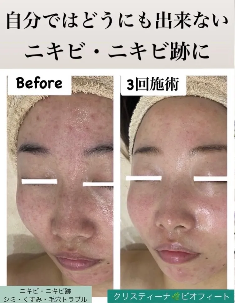 【尼崎】繰り返すニキビ・ニキビ跡・赤みに悩む方へ｜肌質改善で“再発しない肌”へ  
