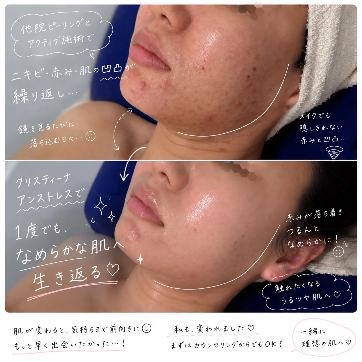 【JR尼崎・肌質改善】他院のピーリングで悪化した赤み・ニキビ…「アンストレス」でなめらか肌へ！ •