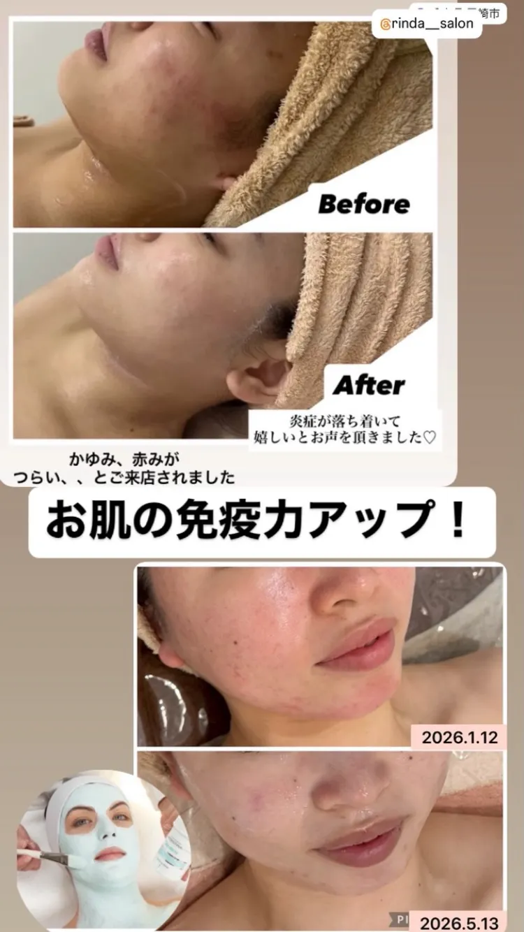 【尼崎・エステ】繰り返す赤みや花粉による肌荒れ…「もう手遅れ？」と諦める前に、お肌の免疫力を高めませんか？