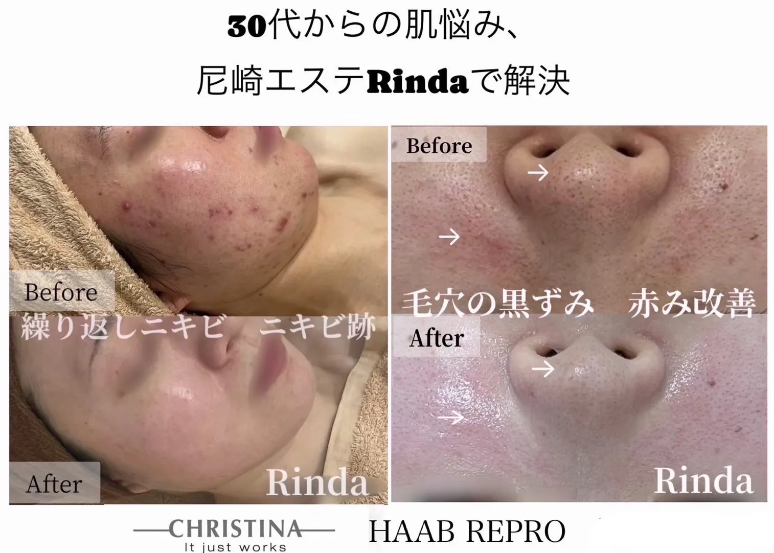 【JR尼崎駅前/肌質改善フェイシャルサロン・口周りのニキビ】繰り返す悩みから卒業。自分にぴったりの「ハーブピーリング」で肌質改善へ