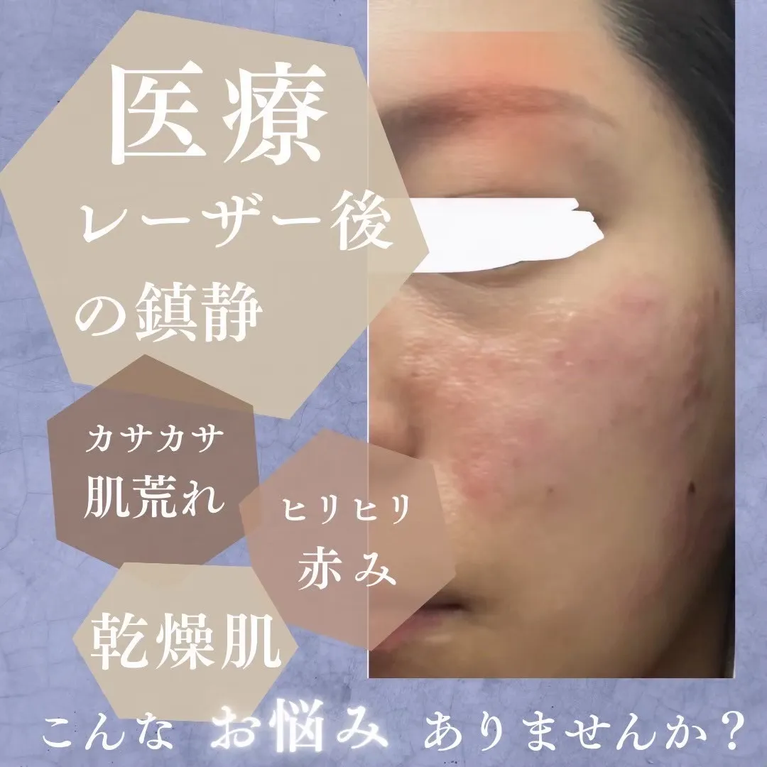 【尼崎でレーザー後の肌ケア】赤み・乾燥・色素沈着予防に。ダメージを最小限に抑える鎮静ケア