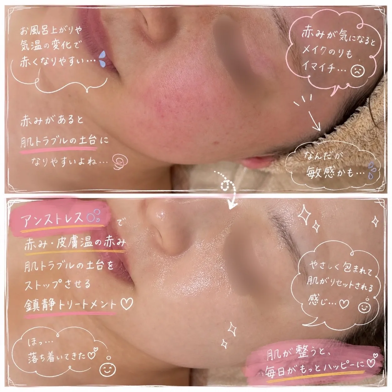 JR尼崎駅前【肌の赤み・ヒリヒリ・敏感肌に】温度変化や乾燥に負けない肌へ導く「アンストレス」で水分満タンの潤い肌へ