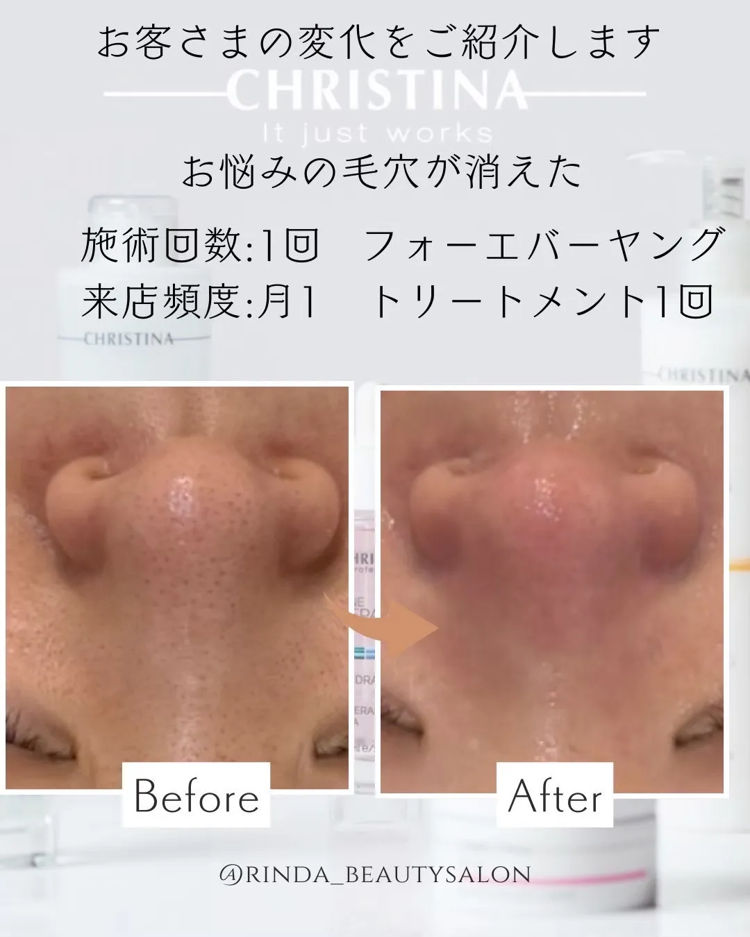 【JR尼崎】1回で毛穴が消えた!?リフトアップと毛穴引き締めを同時に叶える肌質改善エステはRindaBeautySalonリンダビューティーサロンへ