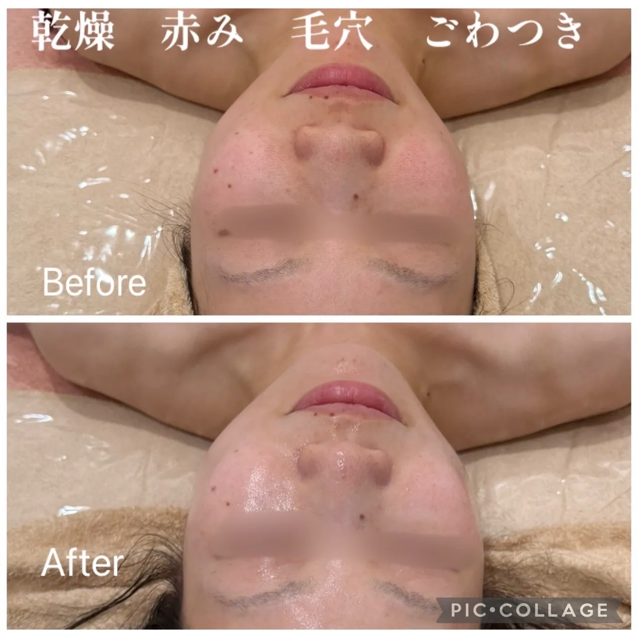 【尼崎で肌質改善】乾燥・ゴワつきをリセット！3ヶ月で自信が持てる「ノーファンデ美肌」