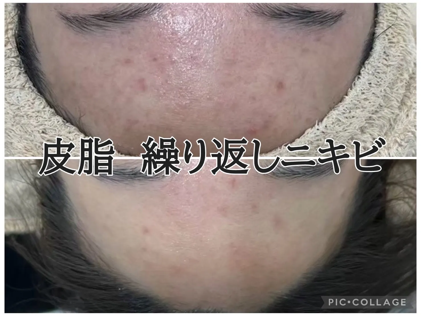 【尼崎エステ】ニキビ、肌荒れ、ごわつき、くすみ、毛穴のお悩みに！肌質改善も肩・首のコリも同時にケア！一石三鳥のフェイシャルエステを受けるならRindaリンダへお越しください