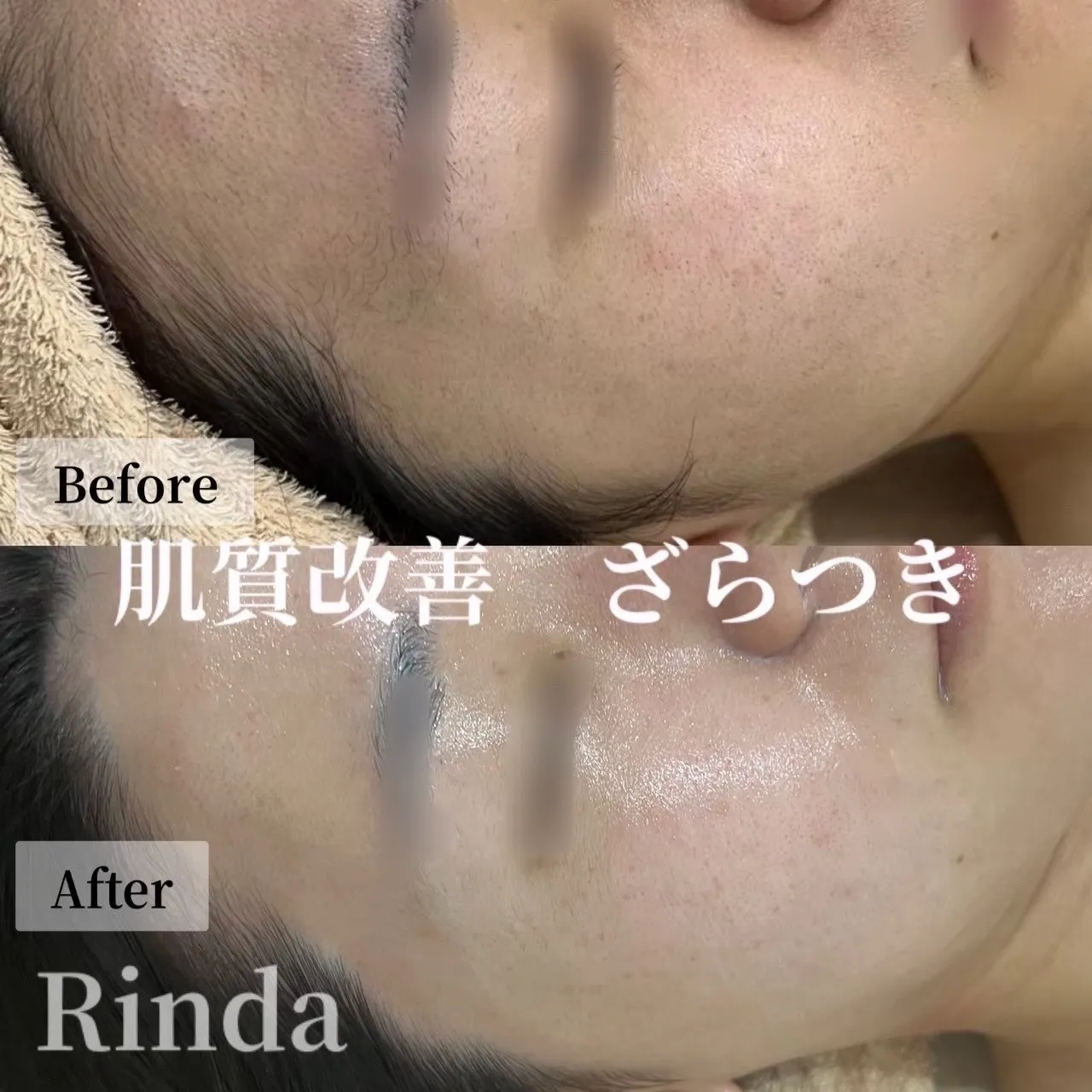 【尼崎で赤み・敏感肌・ニキビにお悩みの方へ】肌質改善でざらつき・ごわつき・毛穴まで根本からケアするならRinda Beauty Salonリンダビューティーサロンへ