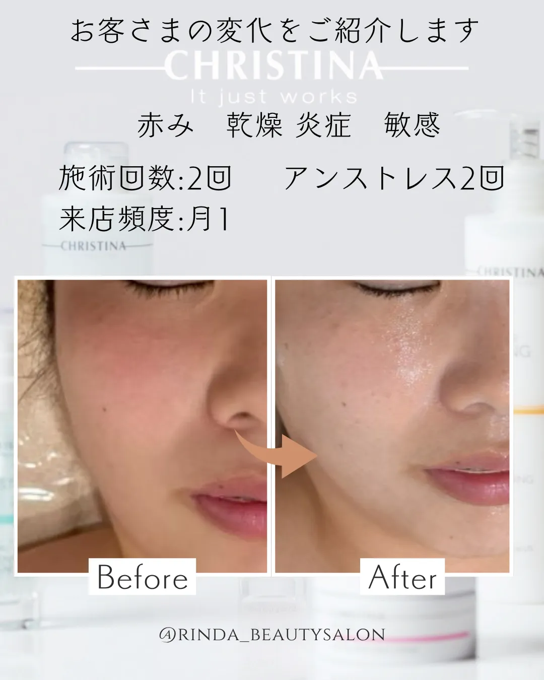 【尼崎で毛穴レス・赤み・敏感肌を改善したい方はRinda BeautySalonリンダビューティーサロンへ】クリスティーナ「アンストレス」でゆらがない健やかな肌へ
