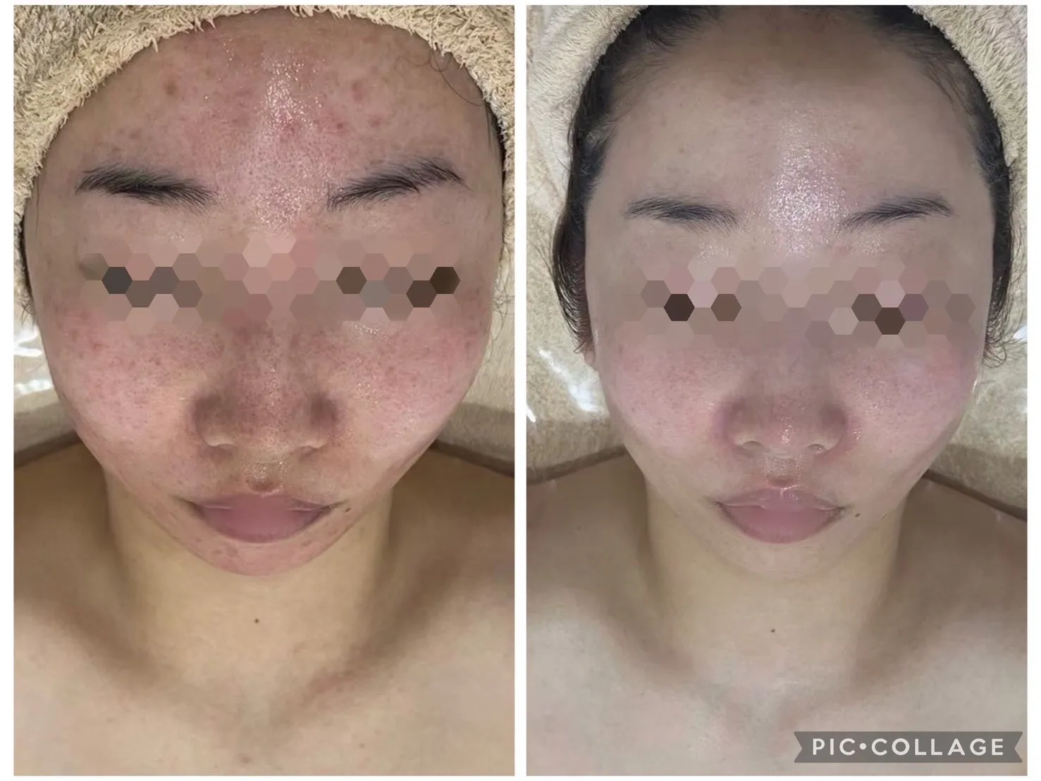 【尼崎】毛穴の黒ずみ・開き・いちご鼻でお悩みの方はRinda Beauty Salonリンダビューティーサロンへ｜3ヶ月で肌質改善を目指す専門サロン