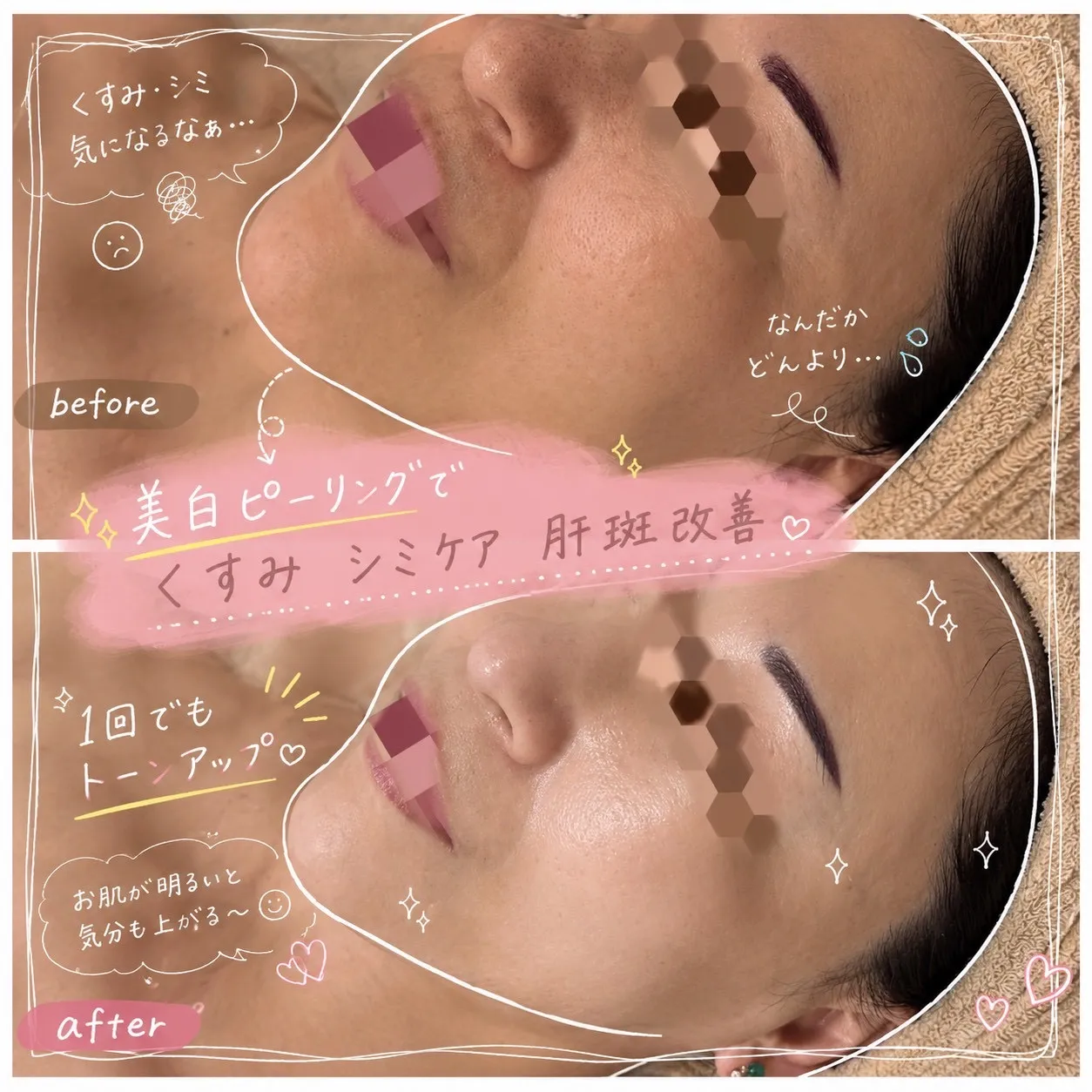 【尼崎】くすみ・シミ・肝斑が気になる方はRinda Beauty Salonリンダビューティーサロンへ｜美白ピーリングで透明感のある素肌へ