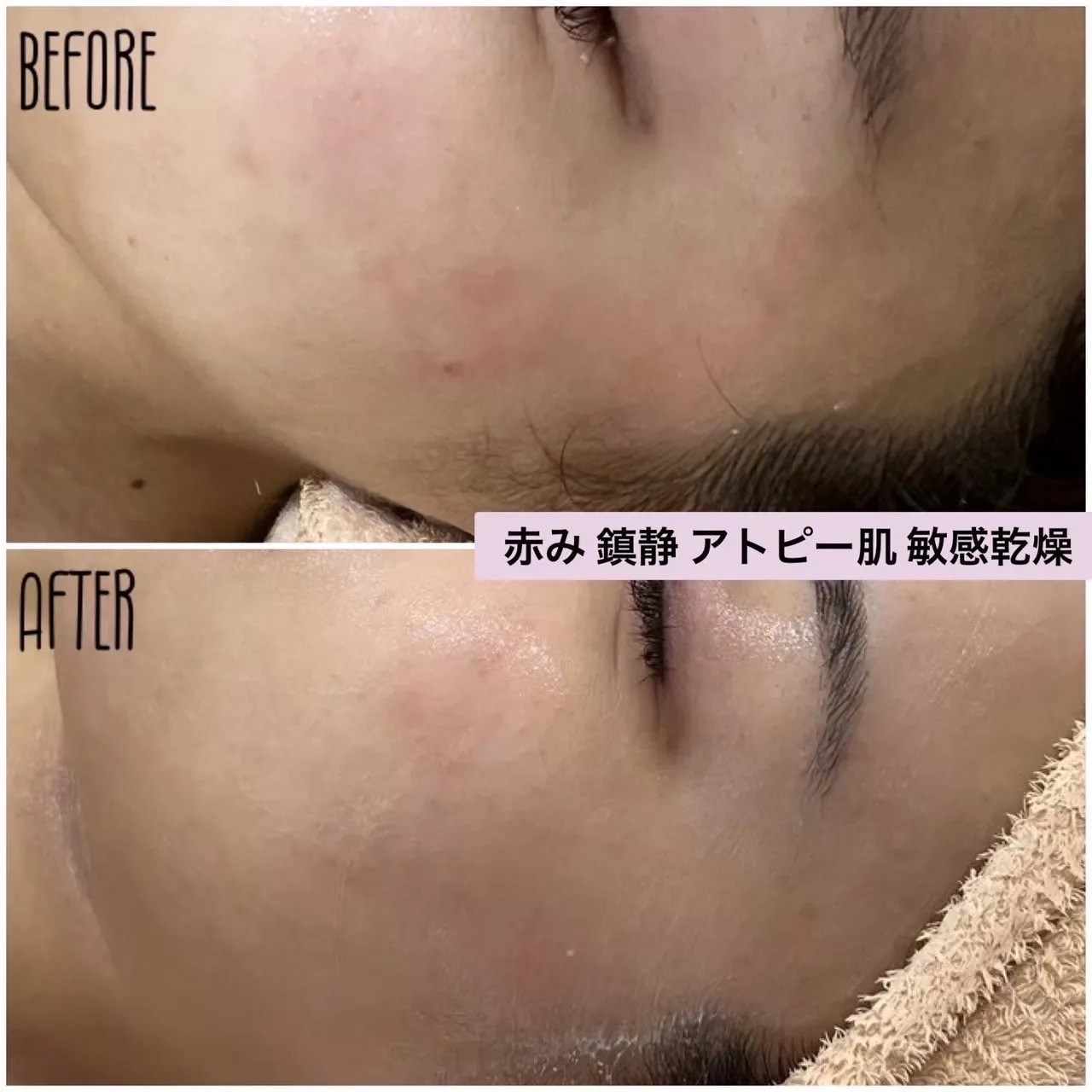 尼崎の肌質改善専門サロン｜赤み・敏感肌・ 毛穴・ニキビ改善なら Rinda Beauty Salonリンダビューティサロンへ