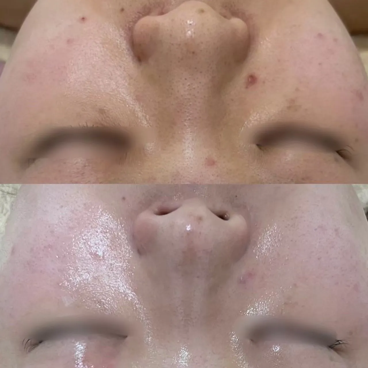 崎の肌質改善専門サロン｜赤み・敏感肌・ 毛穴・ニキビ改善なら Rinda Beauty Salonリンダビューティサロン