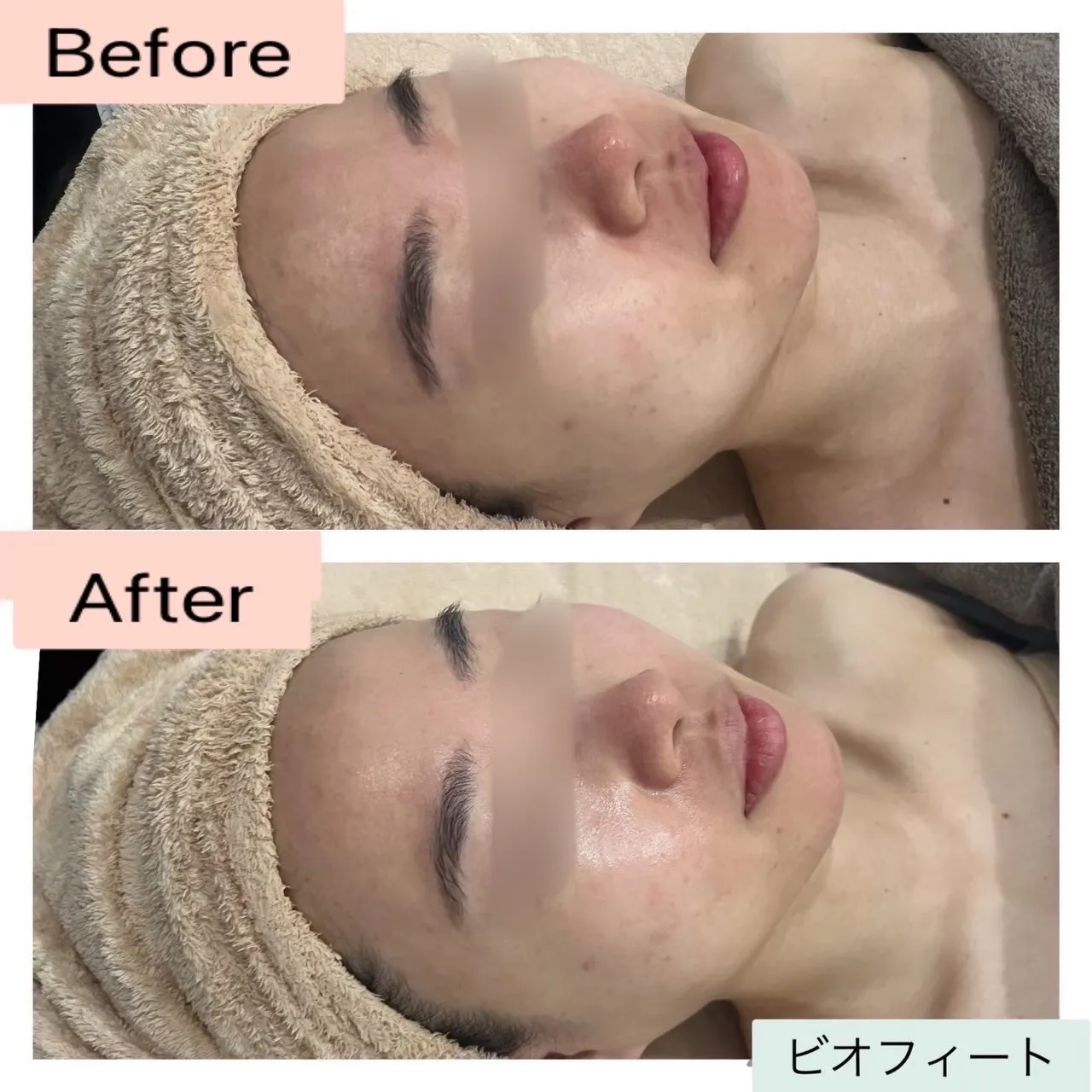 尼崎の肌質改善専門サロン｜赤み・敏感肌・ 毛穴・ニキビ改善なら Rinda Beauty Salon