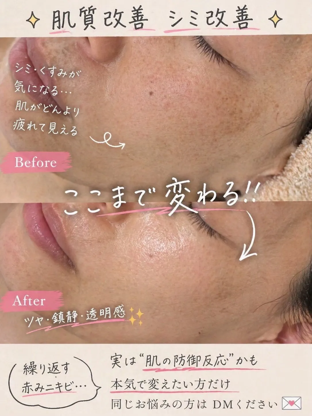 尼崎の肌質改善専門サロン｜シミ・赤み・敏感肌・ 毛穴・ニキビ改善なら Rinda Beauty Salonリンダビューティーサロンへ