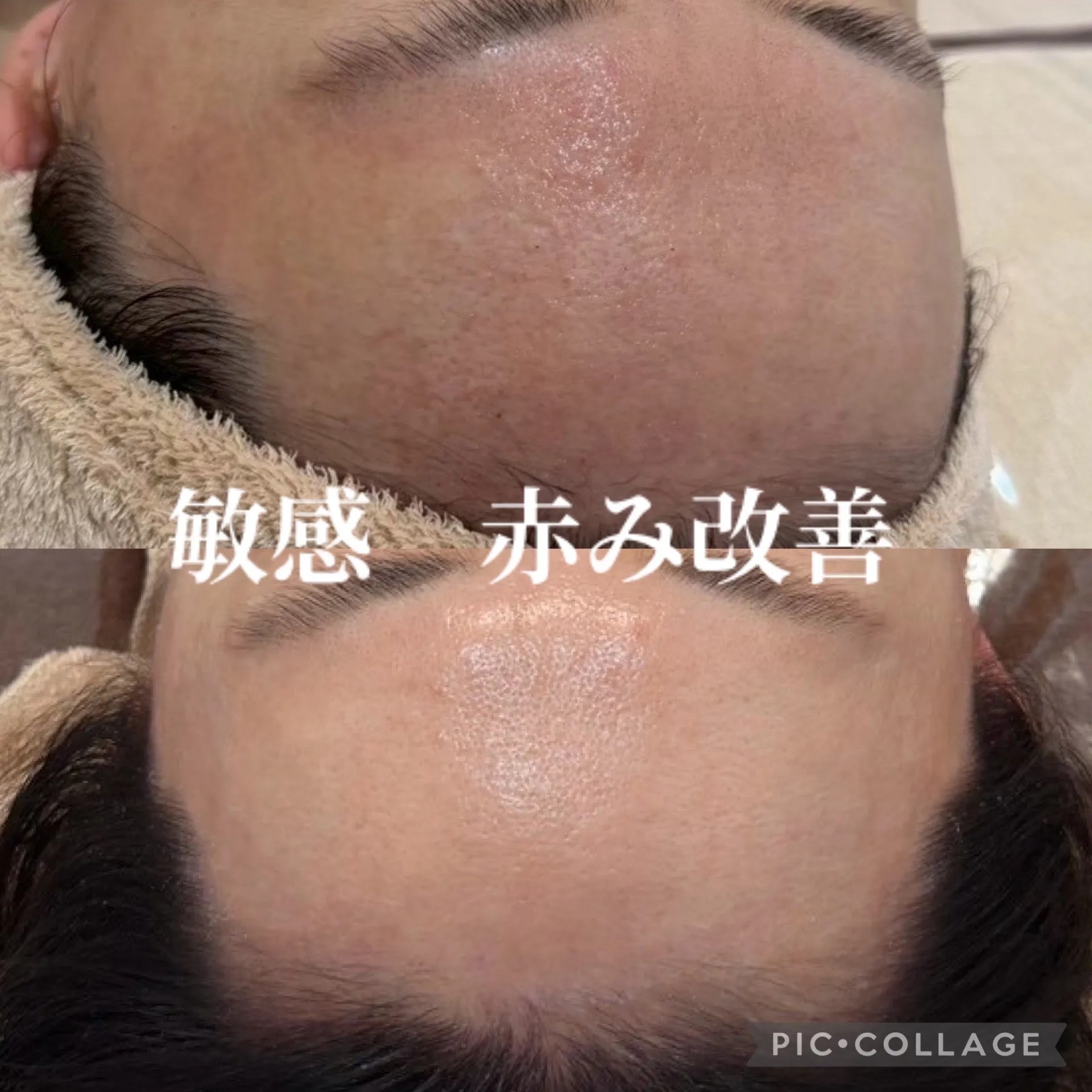 【尼崎の敏感肌・赤み改善】ゆらぎ肌を繰り返さないために。アンストレスで肌質改善