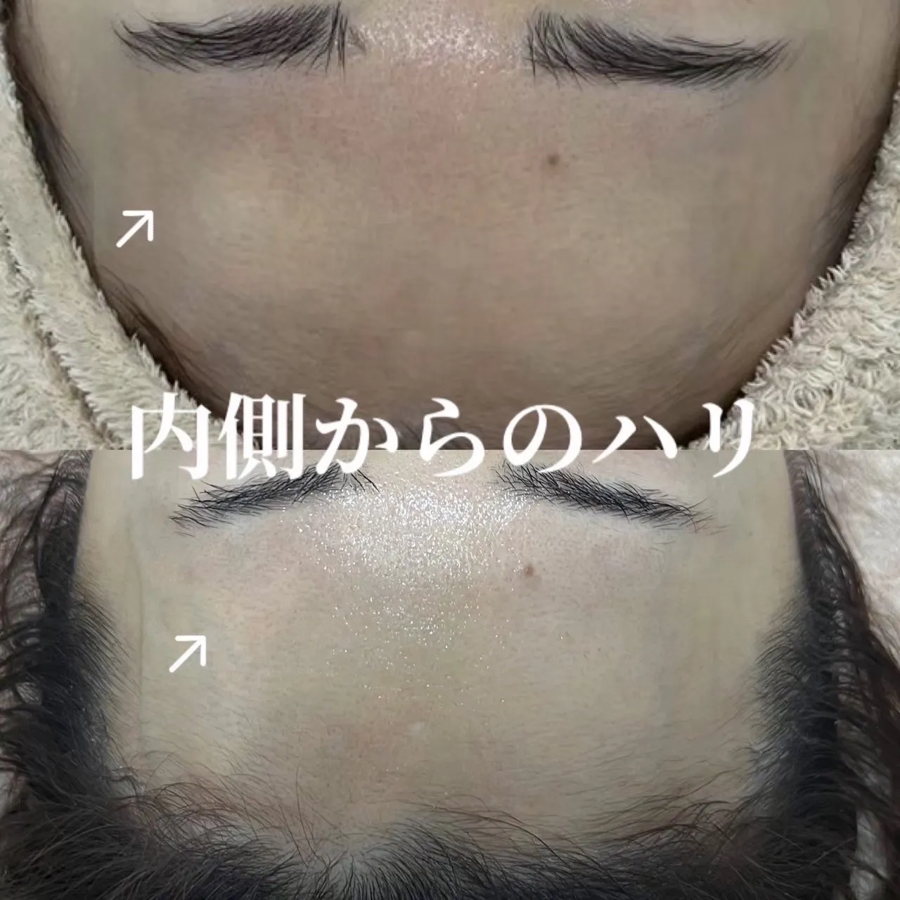 【尼崎でハリ・弾力ケア】フォーエバーヤングで内側からふっくらとした若々しい肌へ