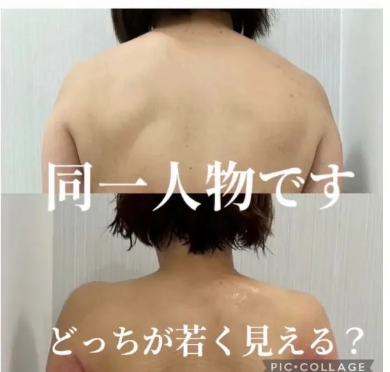 首・肩こりが肌荒れにつながる？肌質改善との相乗効果で根本から美しい肌へ（兵庫県尼崎エステ）Rindaリンダで改善しませんか？