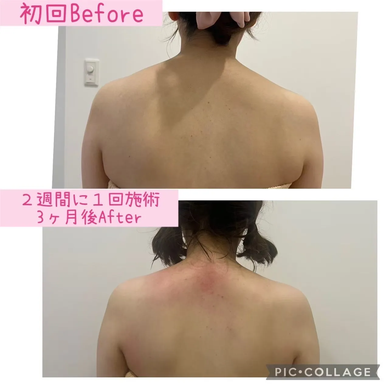 肌悩み改善には首肩こりの詰まりも取ることがオススメ！兵庫県尼崎エステRindaリンダで赤み、毛穴、ニキビ炎症肌のお悩みの方へ