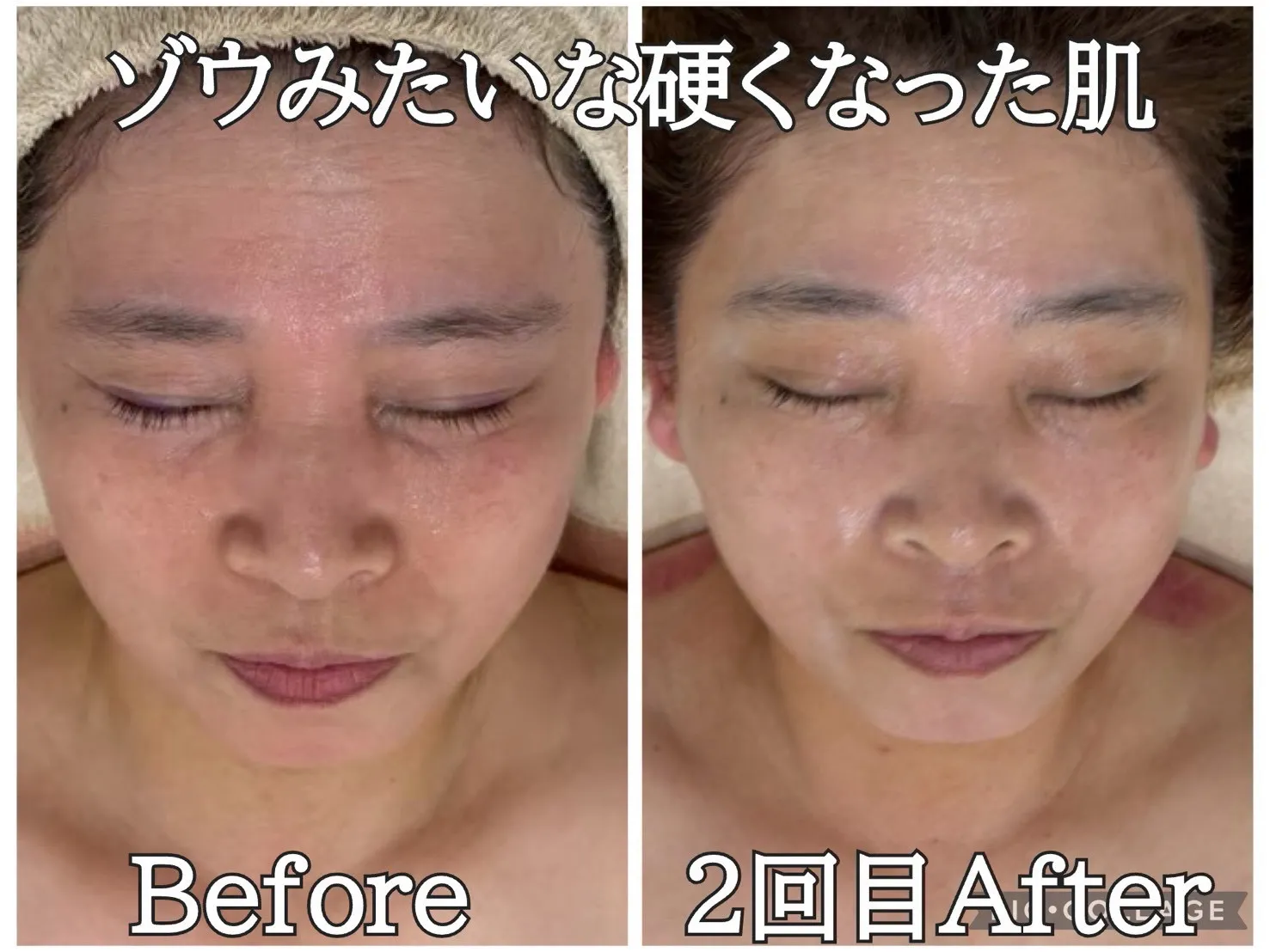寒暖差による「敏感・赤み・乾燥」にお悩みの方へ｜尼崎の肌質改善サロン Rinda Beauty Salonリンダビューティーサロン