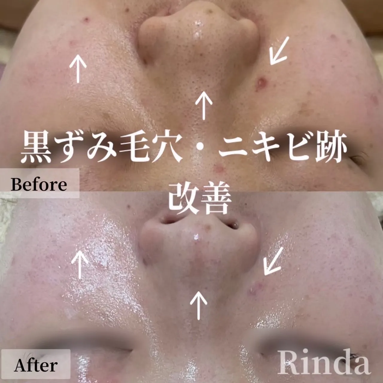 尼崎で黒ずみ毛穴・ニキビ跡の肌質改善なら|Rinda Beauty Salonリンダビューティーサロン(尼崎エステ)