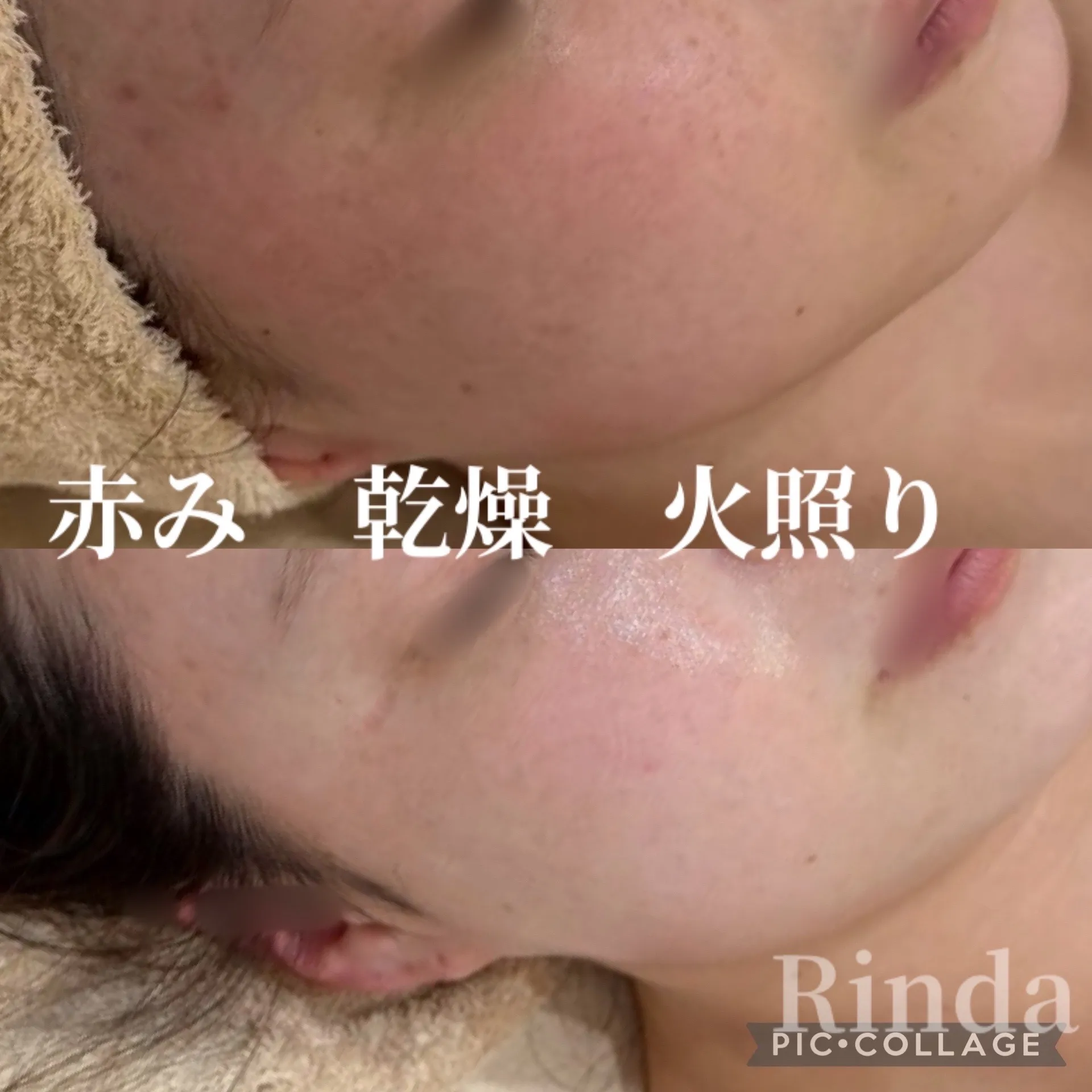赤み・乾燥・寒暖差による火照りが気になる方へ|JR尼崎駅前の肌質改善エステ Rindで改善しませんか?