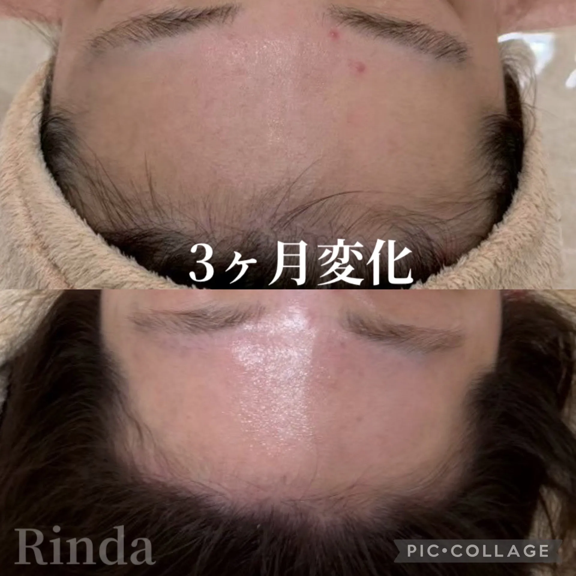 【尼崎エステ】3ヶ月の肌変化！ニキビ・ニキビ跡・ごわつき・テカリの肌質改善