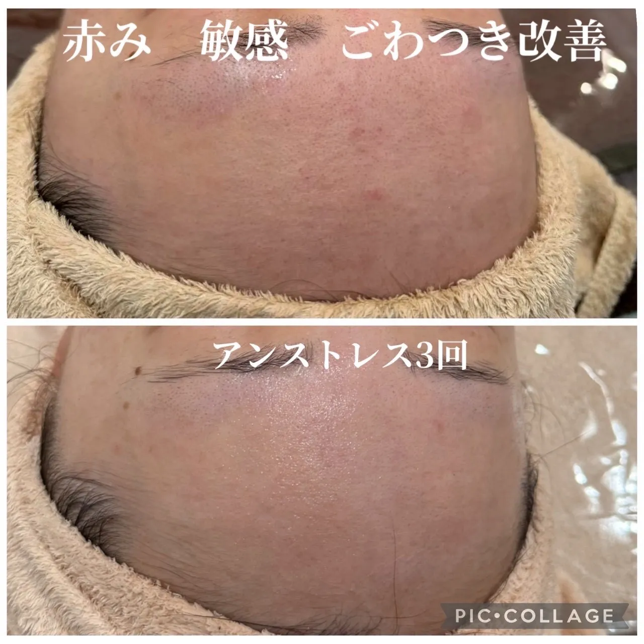 尼崎・JR尼崎】赤み・敏感・ごわつきの肌質改善｜アンストレス3回の症例