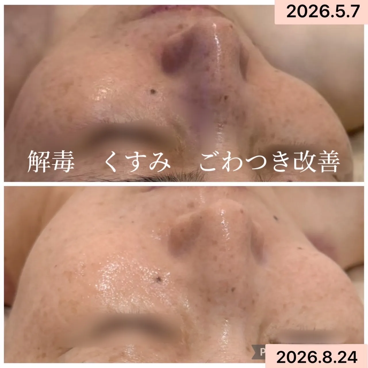 尼崎でエイジングケア】くすみ・ごわつき・ハリ不足の肌質改善