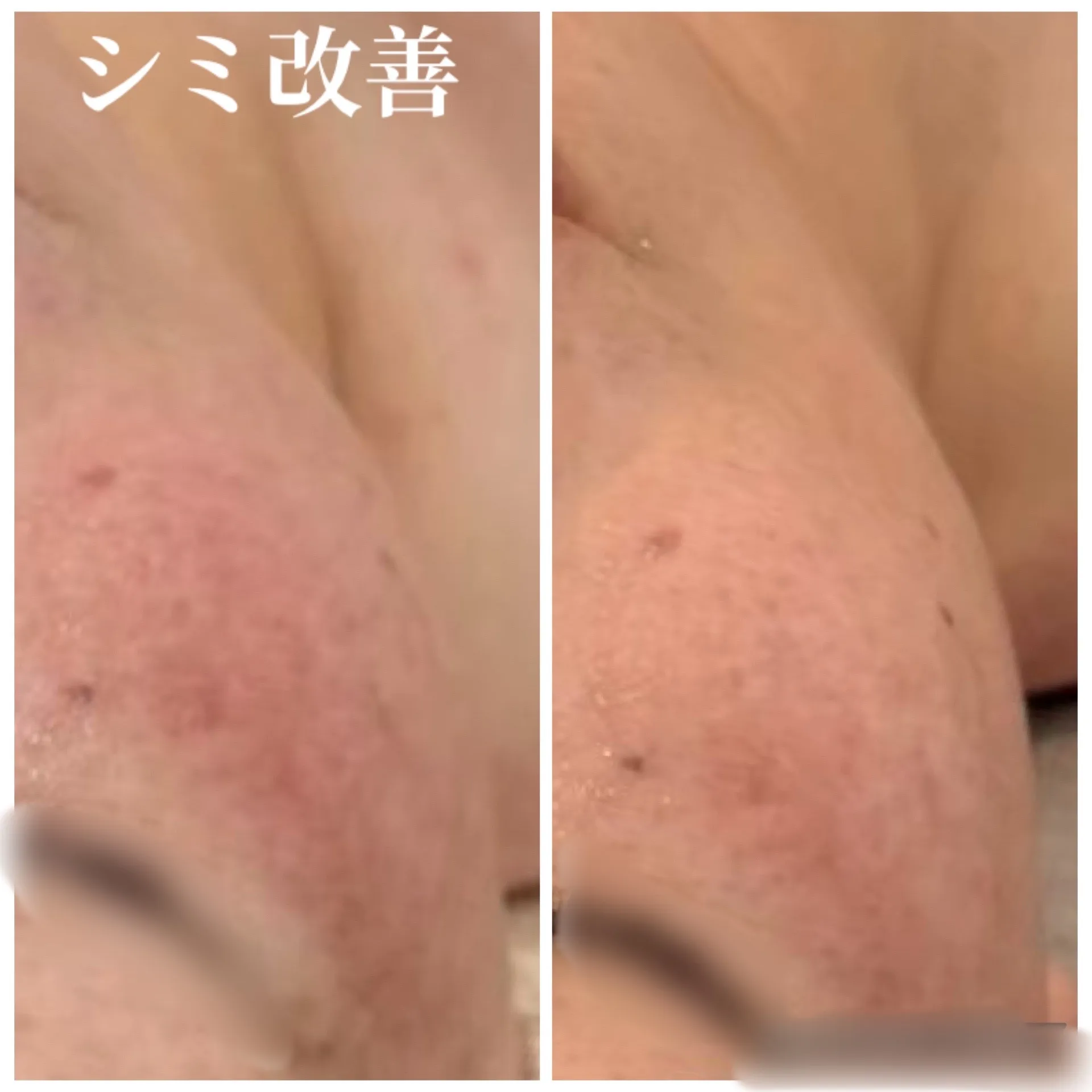 JR尼崎駅近郊】何をしてもダメだった頑固なシミに！肌質改善専門サロンだから叶う、本気のシミケア 本文：