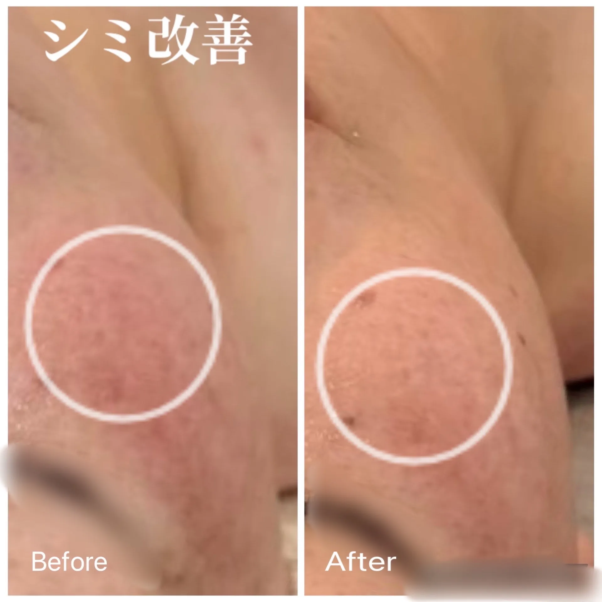 【JR尼崎駅近郊】何をやってもダメだった赤み・毛穴に！本気で肌質を変える改善サロン