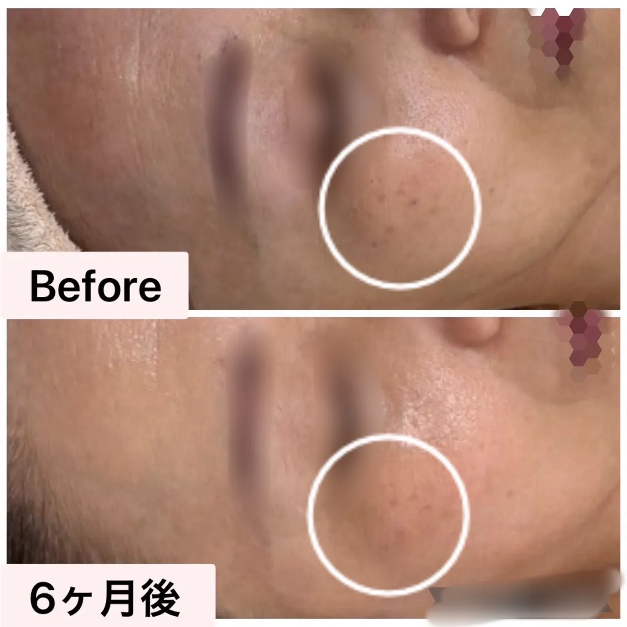 【尼崎・JR尼崎】シミが気になる方へ｜6ヶ月の肌質改善症例