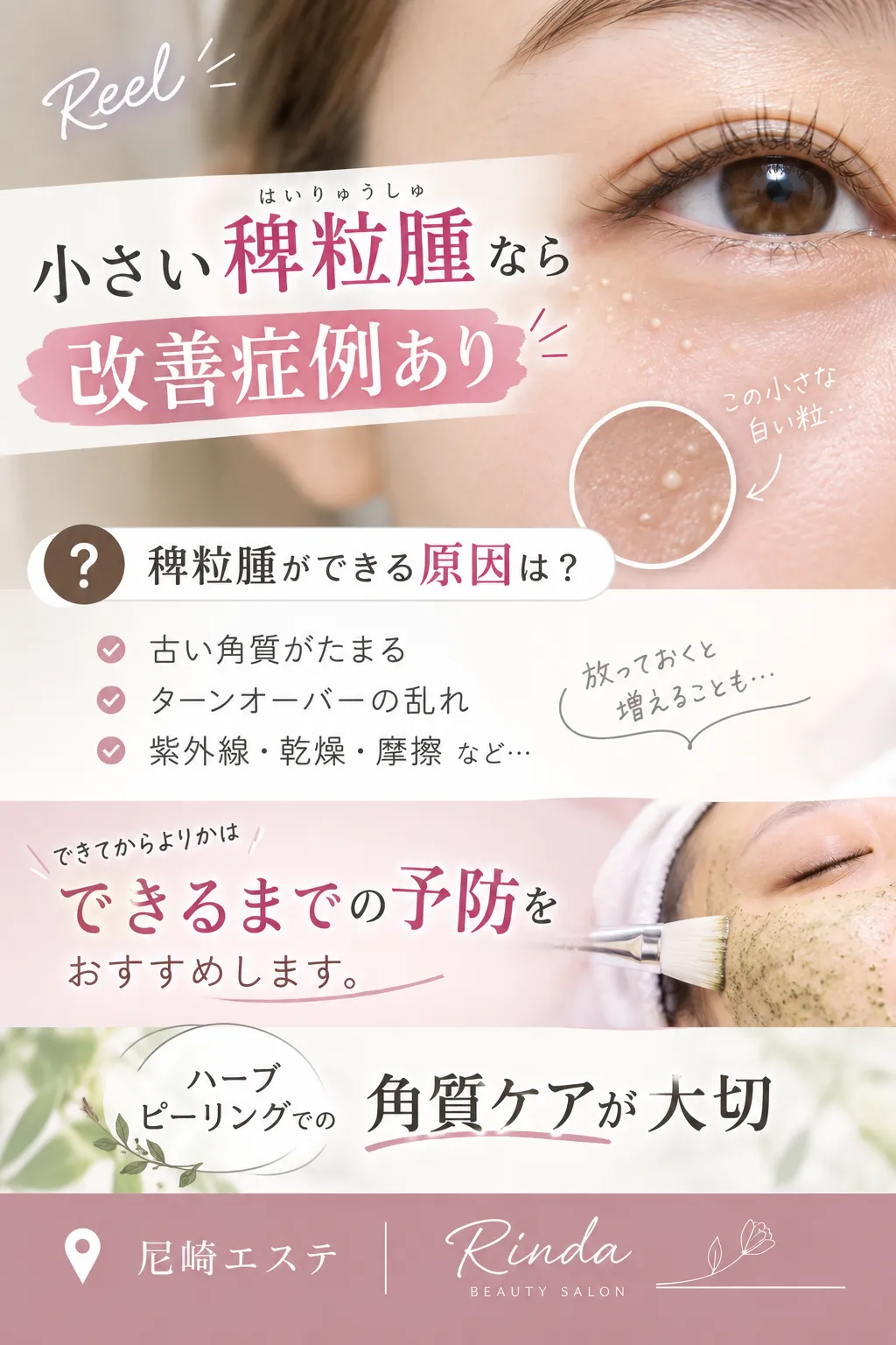 稗粒腫（はいりゅうしゅ）が気になる方へ｜できてからより「できにくい肌環境」を。尼崎のハーブピーリング・肌質改善