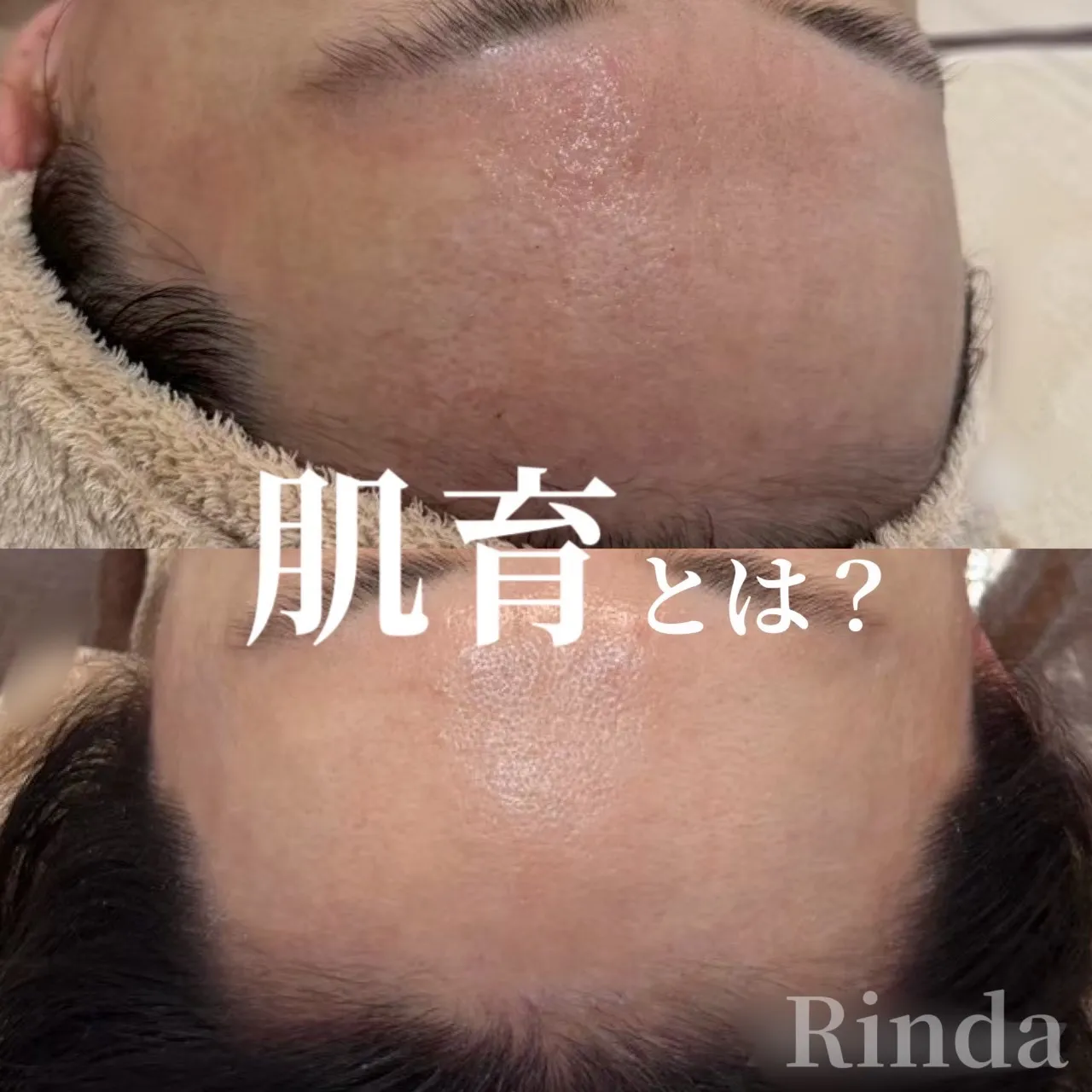 尼崎の肌質改善｜肌育とは？赤み・乾燥・毛穴・ニキビを繰り返さない肌管理