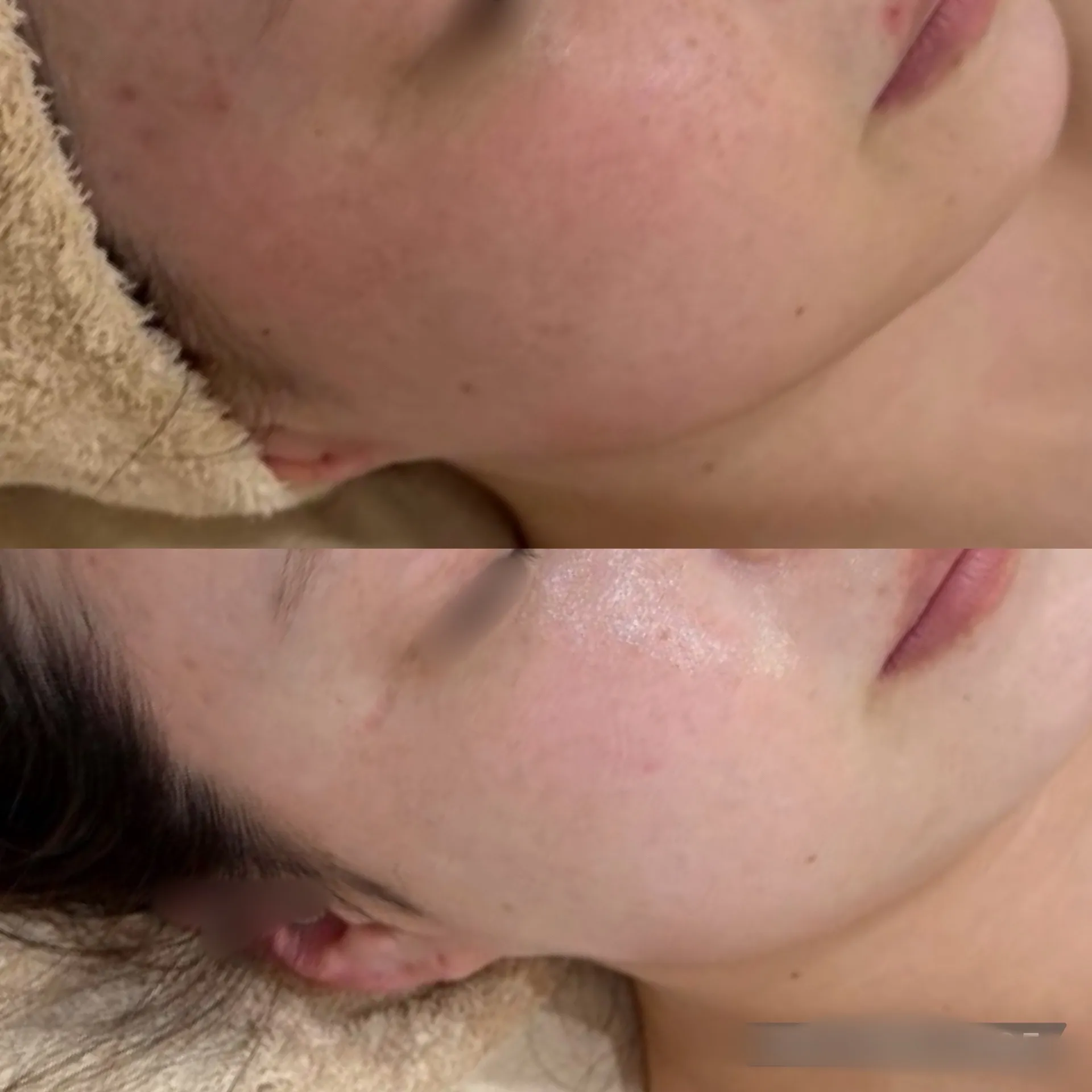 尼崎で赤み・炎症・敏感肌・ニキビ改善｜肌質改善専門 Rinda Beauty Salon
