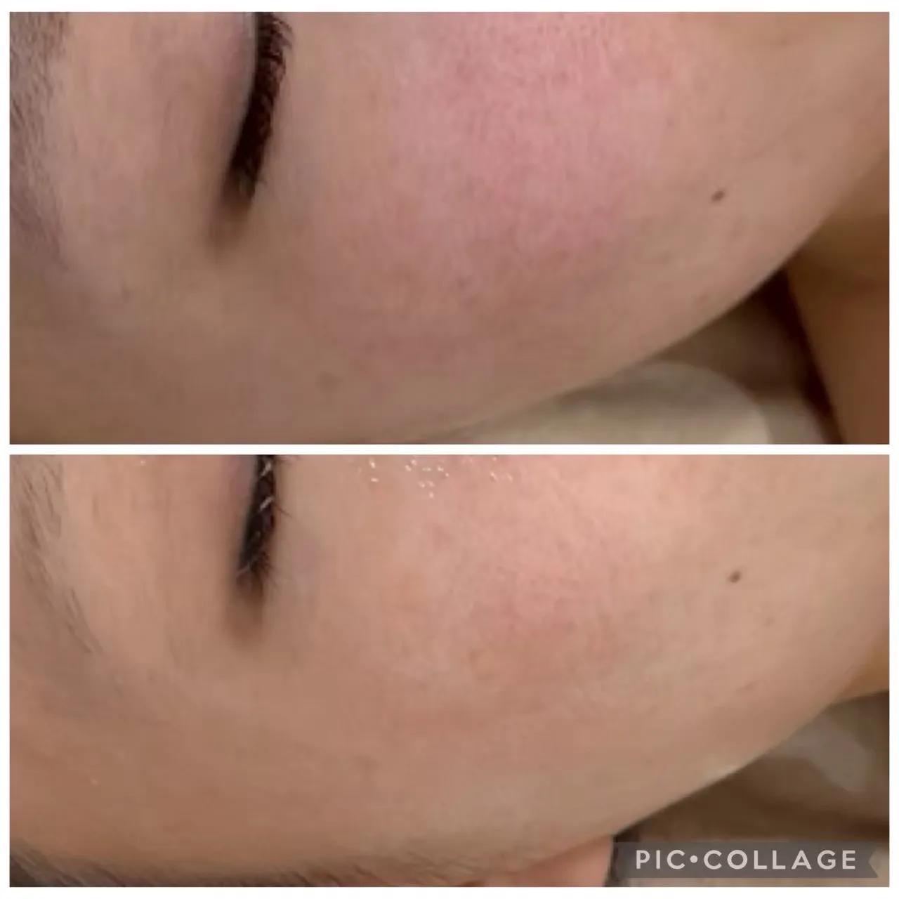 尼崎の赤み改善｜敏感肌・乾燥肌の肌質改善ならRinda Beauty Salonリンダビューティーサロン