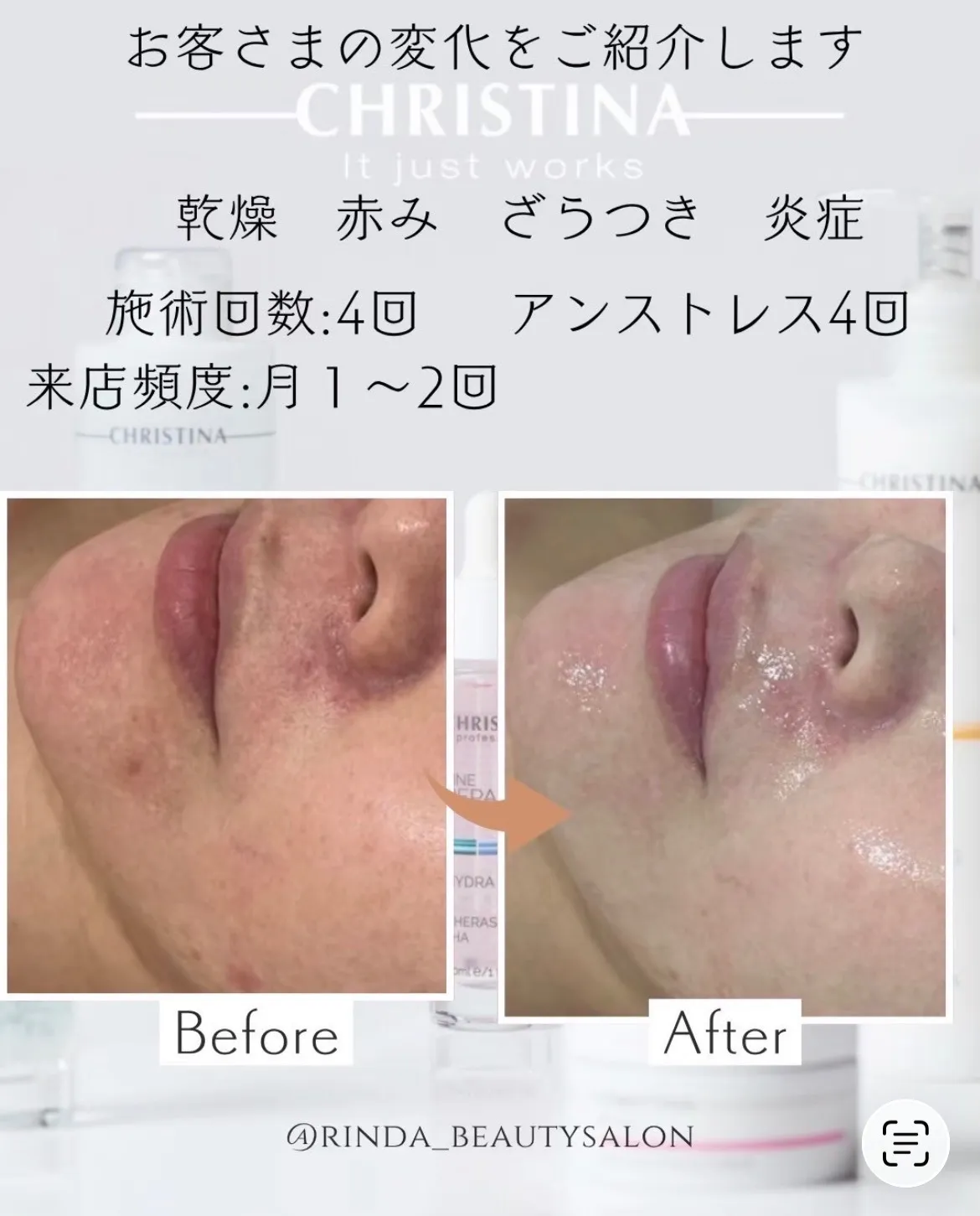 赤み・乾燥・ざらつきが気になる方へ｜アンストレス4回の肌変化【尼崎・肌質改善】