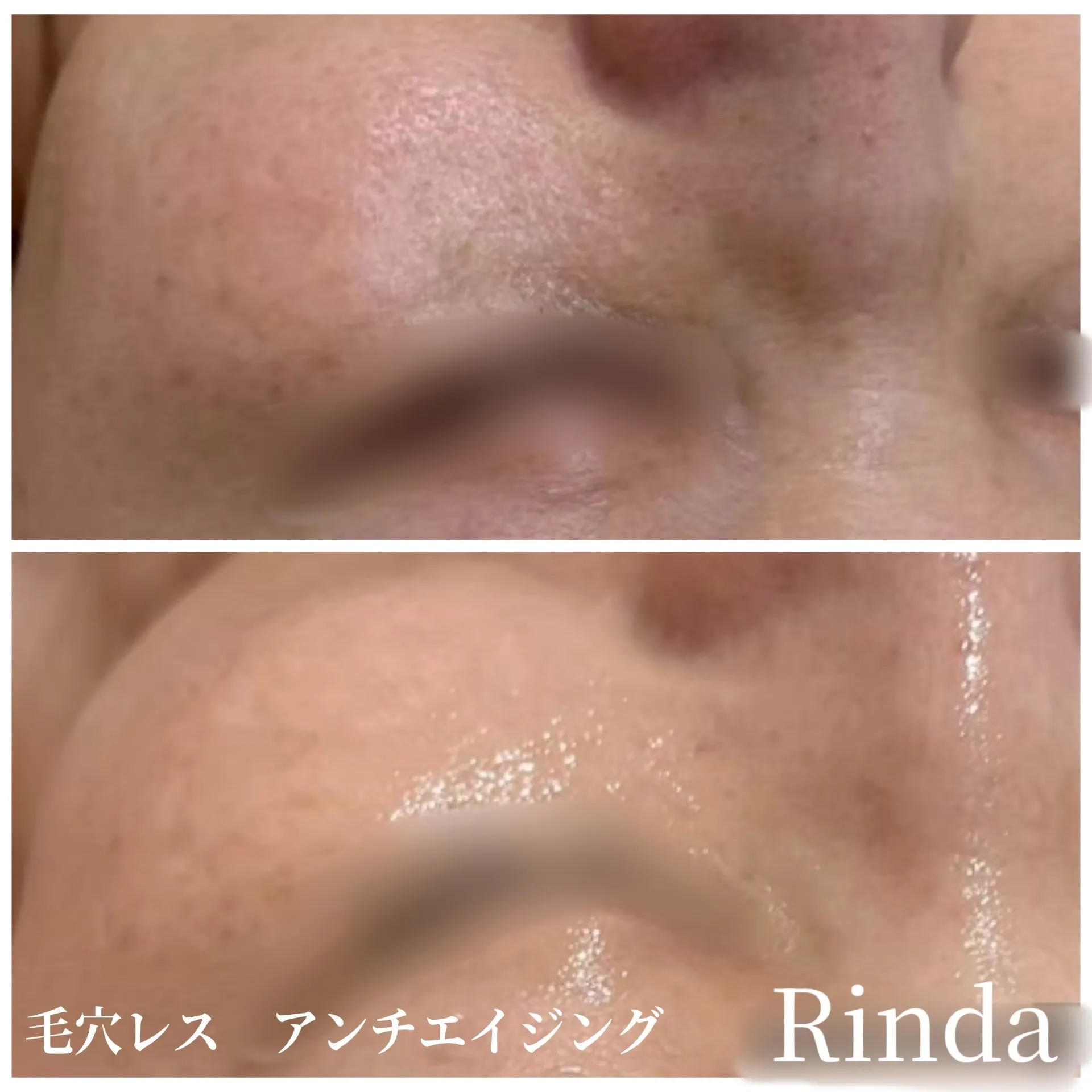 JR尼崎でアンチエイジング・シミ・くすみ・美白ケアなら|肌質改善Rinda Beauty Salonリンダビューティーサロンで改善